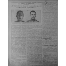 1916 EX CHIRURGIE TRAITEMENT BRULURES GUERRE VISAGE BRULE SOIGNE L'AMBRINE