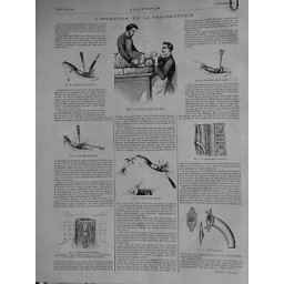 1888 P MEDECINE TRACHEOTOMIE OPERATION CANULE TRACHEE OUVERTURE