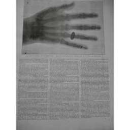 1912 RADIO RAYON X RADIOGRAPHIE COEUR STOL RUTT COUREUR ROENTGEN 4 JOURNAUX